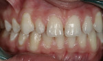 Figure 2  Retracted right side view showing the “peg” lateral No. 7 with tissue that is more coronal than ideal; also note slight gingival recession on tooth No. 28.