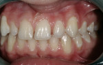 Figure 3  Retracted left side showing spacing of maxillary teeth; note the gingival recession on tooth No. 21.