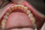 Figure 4  Occlusal view of mandibular arch: no occlusal wear and no previous restorations.