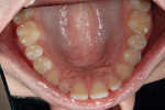 Figure 5  Occlusal view of maxillary arch shows palatal view of spacing of incisors and no previous restorations or occlusal wear.