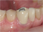 Figure 1 Fractured porcelain off the incisal third of tooth No. 27.