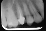 Figure 5 Radiograph of tooth No. 4 before the repair.