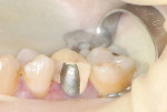 Figure 6 Photograph of the fractured facial porcelain off tooth No. 4.