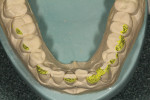 Figure 6 The mandibular preoperative model was reduced so that the restorations being fabricated on the maxillary arch could conform to proper curve of Wilson and curve of Spee.