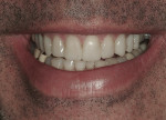 Figure 10 View of the maxillary provisionals in a natural smile.