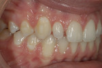 Figure 11  Right lateral view, 1 week postgingival surgery tooth No. 7.