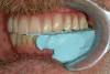 Fig 20. Facial view of screw-retained implant crown.