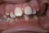 Fig 13. A copy of converted denture that was modified by shaping.
