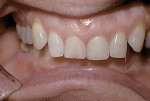 Figure 5 Examples of the ability of these treatment systems to address significant Class II malocclusions in both adolescent and adult populations with a non-extraction, non-surgical approach: Adolescent with Class II malocclusion, pretreatment (3); same