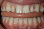 Figure 13  Incisal preparatory guide was used to check appropriate incisal reduction, based on accepted wax-up.