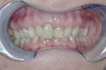 Figure 14 Deep overbite in a narrow maxilla. An example of poor vertical development with a deep bite and excessive curve of Spee in the lower arch.