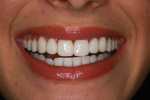 Figure 9 Case 3 post-treatment photograph of patient’s smile.