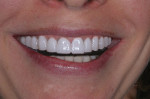 Figure 21 Case 7 close-up imaged smile.