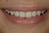 Fig 8. Intraoral pre-operative photograph showing multiple missing posterior teeth in both arches.