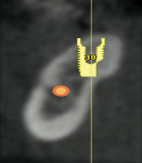Figure 1  A CT scan is taken prior to implant surgery and a simulation program used to place a 4-mm x 9-mm implant in site No. 30.