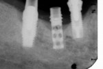 Figure 6  Radiograph of the two peri-implantitis-affected implants seen in Figure 5.