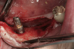 Figure 7  Healed ridge 6 months postsurgery prior to implant placement.