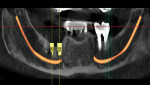 Figure 9  Panoramic simulation of implant Nos. 29 and 30 showing proximity to the IAN canal.