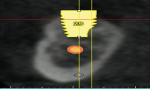 Figure 10  Axial section of the CT scan showing proximity of implant No. 29 to IAN.