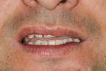 Figure 11  Clinical photograph of a patient who presented with a complaint of partial lower lip numbness, which has remained for 18 months, after the implant restoration was completed.