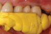 Fig 7. APRF membrane placement. A “distal-mesial backpack” technique ensures a dense and complete packing of the APRF membranes in the pouch created. Three to 4 membranes are recommended per pair of teeth treated.