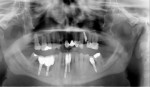 Figure 12  Panoramic radiograph of patient in Figure 5, showing the encroachment of implants Nos. 29 and 30 into the inferior alveolar canal. The dentist told the patient at the time of implant restoration that the feelings would probably return. How
