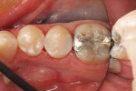 Figure 4 Intraoral photo of the final mesial-occlusal-distal restoration on tooth No. 20 and the distal-occlusal restoration on tooth No. 21 show the final results produced.