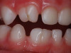 (14.) Occlusal view. Some form of augmentation would be needed if implants were being considered.