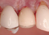 Fig 5 and Fig 6. Implant restorations on the maxillary lateral incisors and right first bicuspid supporting a cement-retained PFM fixed partial denture on Nos. 7 through 10, a single PFM on No. 6, and a cement-retained PFM on No. 5. Retracted view (Fig 5), and smile view (Fig 6). (Photographs courtesy of Linda Cirtaut, DDS)