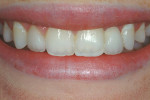 Figure 15  The completed smile for this patient.