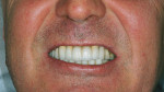 Figure 19  The final tooth and dental implant-supported maxillary fixed prosthesis achieved a more convex incisal edge line. Corrections of DM to FM, DV to FV, and DH to FH also were achieved and the maxillary central incisors were centered in the fa