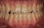 Figure  1  Initial patient presentation in June 2005. Frontal view.Notice Class III malocclusion and generalized recession defects.