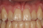 Figure  3  Maxillary anterior view depicts Miller Class I recession on teeth Nos. 6 and 11 and a dearth of keratinized mucosa over tooth No. 11. There is a thin tissue biotype.