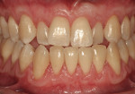 Figure  17  At 10-month, 20-month, and 32-month follow-up of grafted areas Nos. 21 to 28, Nos. 3 to 8, and Nos. 9 to 14, respectively (March 2008). There is symmetry between the maxillary and mandibular anterior teeth, as well as a thickened biotype.