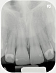 Figure  3  Initial upper anterior radiograph taken in 2008.
