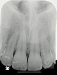 Figure  13   Final upper anterior radiograph taken in 2009.