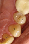Figure  12  Class A RSBI on the lingual aspects of teeth Nos. 10, 11, and 12. The facial aspect of No. 12 represents a Class B RSBI (Figure 13). Note adequate soft tissue support at the CEJ.