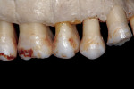 Figure  17  Fenestrations without gingival recession.
