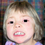 Figure  1  Facial characteristics of children with Kabuki syndrome.