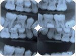 Figure  6  Bitewing radiographs (taken 3 months before presentation). Note normal osseous anatomy.