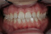 Fig 2. Sealants placed mandibular second premolar and second molar.