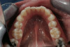 Fig 3. Minimally invasive Class II slot preparation maxillary first premolar.