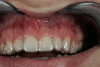 Fig 4. Class II restoration of maxillary first premolar using a self-etch adhesive.
