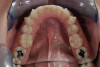 Fig 7. Maxillary incisors etched with phosphoric acid etchant.