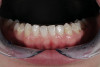 Fig 8. Esthetic restoration of the fractured maxillary central incisors using an etch-and-rinse adhesive with a nanohybrid composite resin.