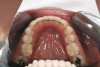 Fig 9. Plan to restore the maxillary lateral incisors and canines with porcelain veneers.