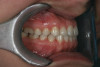 Fig 11. Immediate postoperative view of porcelain veneers and all-ceramic crowns placed using an etch-and-rinse adhesive.