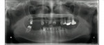 Figure  6  Preoperative full-mouth radiographs.