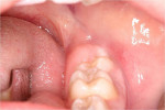 Figure  2  Alternative harvest site distal to tooth No. 18.