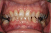 Fig 1. Occlusal contacts on the provisional.